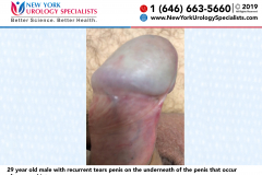 7076_29-year-old-male-with-recurrent-tears-penis-on-the-underneath-of-the-penis-that-occur-after-sexual-intercourse 7076_29-year-old-male-with-recurrent-tears-penis-on-the-underneath-of-the-penis-that-occur-after-sexual-intercourse