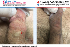 6662a_and_8248_Before-and-2-months-after-penile-cyst-removal