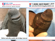 6667and6672_Before-and-after-penile-skin-bridge-removal-smaller