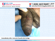 6671_Immediately-after-removal-of-penile-skin-bridge