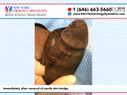 6672_Immediately-after-removal-of-penile-skin-bridge