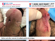 7450and7453_Before-and-after-removal-of-multiple-penile-skin-bridges-smaller