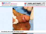 FJSC3274_Immediately-after-penile-skin-bridge-removal