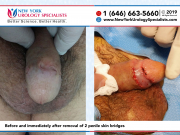 KBNO1555andFJSC3274_Before-and-immediately-after-removal-of-2-penile-skin-bridges-smaller