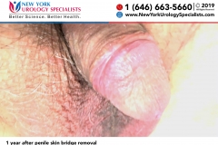 4880_1-year-after-penile-skin-bridge-removal