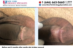 5113and5724_Before-and-2-months-after-penile-skin-bridge-removal-smaller