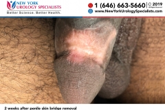 5692_2-weeks-after-penile-skin-bridge-removal-smaller