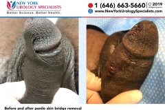 6667and6672_Before-and-after-penile-skin-bridge-removal-smaller