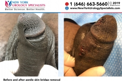 6667and6672_Before-and-after-penile-skin-bridge-removal-smaller 6667and6672_Before-and-after-penile-skin-bridge-removal-smaller