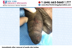 6671_Immediately-after-removal-of-penile-skin-bridge 6671_Immediately-after-removal-of-penile-skin-bridge