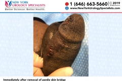 6672_Immediately-after-removal-of-penile-skin-bridge