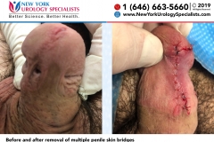 7450and7453_Before-and-after-removal-of-multiple-penile-skin-bridges-smaller
