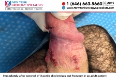 7456_Immediately-after-removal-of-3-penile-skin-bridges-and-frenulum-in-an-adult-patient-smaller