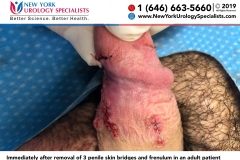 7456_Immediately-after-removal-of-3-penile-skin-bridges-and-frenulum-in-an-adult-patient-smaller 7456_Immediately-after-removal-of-3-penile-skin-bridges-and-frenulum-in-an-adult-patient-smaller