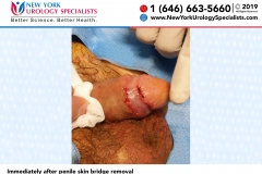 FJSC3274_Immediately-after-penile-skin-bridge-removal