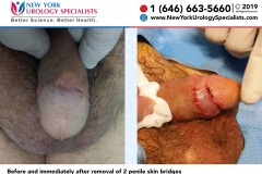 KBNO1555andFJSC3274_Before-and-immediately-after-removal-of-2-penile-skin-bridges-smaller KBNO1555andFJSC3274_Before-and-immediately-after-removal-of-2-penile-skin-bridges-smaller