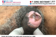 Penile-skin-bridge-in-an-adult-male-circumcised-as-a-child Penile-skin-bridge-in-an-adult-male-circumcised-as-a-child