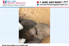Penile-skin-bridges-in-an-adult-male Penile-skin-bridges-in-an-adult-male