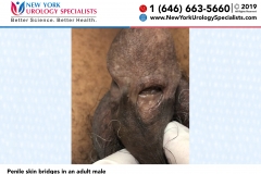 Penile-skin-bridges-in-an-adult-male Penile-skin-bridges-in-an-adult-male