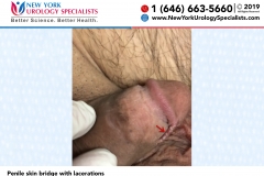 Penile-skin-bridge-with-lacerations Penile-skin-bridge-with-lacerations