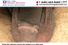 5113_Penile-skin-adhesion-penile-skin-bridge-smaller 5113_Penile-skin-adhesion-penile-skin-bridge-smaller