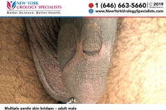 5262_Multiple-penile-skin-bridges-–-adult-male-smaller 5262_Multiple-penile-skin-bridges-–-adult-male-smaller