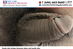 6666_Penile-skin-bridge-between-glans-and-penile-skin-smaller 6666_Penile-skin-bridge-between-glans-and-penile-skin-smaller