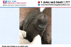 Penile-skin-bridge-in-an-adult-male Penile-skin-bridge-in-an-adult-male
