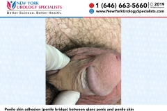 Penile-skin-adhesion-penile-bridge-between-glans-penis-and-penile-skin