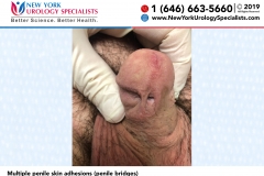Multiple-penile-skin-adhesions-penile-bridges Multiple-penile-skin-adhesions-penile-bridges