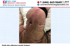 Penile-skin-adhesions-penile-bridges Penile-skin-adhesions-penile-bridges