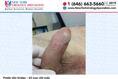 Penile-skin-bridge 63-year-old-male