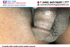 3 months after penile pearly papule removal