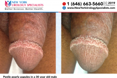 Penile pearly papules in a 30 year old male