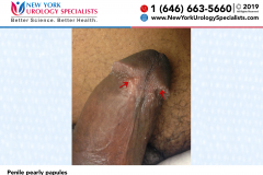 Penile pearly papules Penile pearly papules