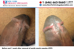 Before and 1 week after removal of penile pearly papules PPP