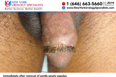 Immediately after removal of penile pearly papules Immediately after removal of penile pearly papules