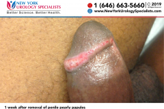 1 week after removal of penile pearly papules