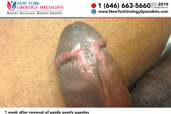 1 week after removal of penile pearly papules small