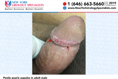 Penile Pearly Papules in Adult Male Penile Pearly Papules in Adult Male