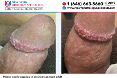 Penile pearly papules in an uncircumcised adult Penile pearly papules in an uncircumcised adult