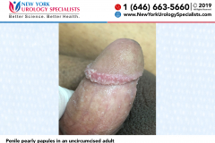 Penile pearly papules in an uncircumcised adult