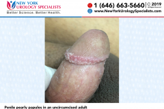 Penile pearly papules in an uncircumcised adult Penile pearly papules in an uncircumcised adult