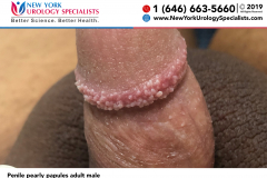 Penile Pearly Papules adult male