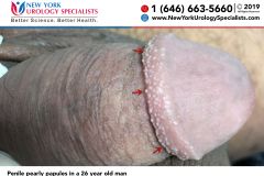 Penile pearly papules in a 26 year old man Penile pearly papules in a 26 year old man