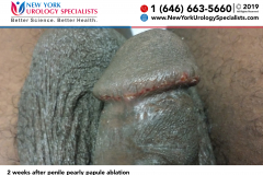2 weeks after penile pearly papule ablation 2 weeks after penile pearly papule ablation