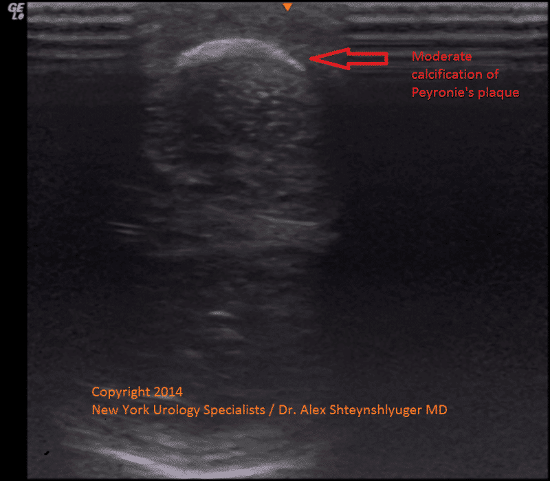 Penile Ultrasound with Doppler for Evaluation of Peyronie