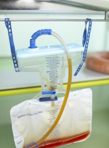 Urinary Foley catheter