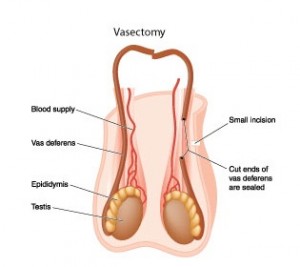 Vasectomía